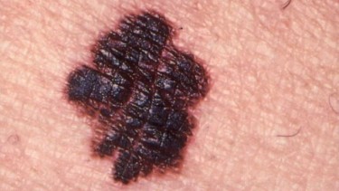 "El melanoma maligno el más grave y delicado para la salud, especialmente cuando no se diagnostica a tiempo", subrayó el especialista.